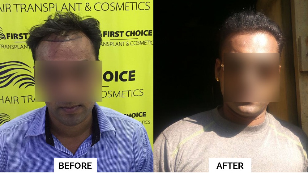 hair transplant Ludhiana result